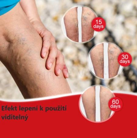 Náplast na křečové žíly 6 kusů (F50)